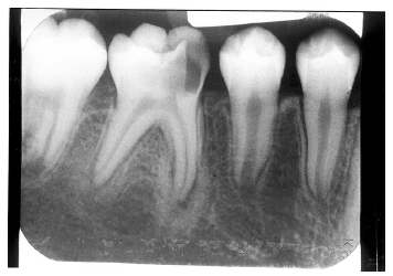 focal sclerosing osteomyelitis