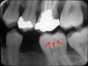 Figure 2. Pit and fissure caries.