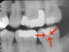 Figure 3. Smooth surface caries and interproximal surface caries.
