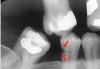 Figure 4. Root surface caries.