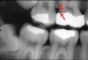 Figure 5. Secondary or recurrent caries.