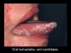 Figure 6. Leukoplakia (Image courtesy of AIDS Image Library <a href=