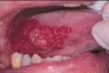 Figure 7. Erythroplakia (Courtesy of NYU College of Dentistry).