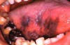 Figure 9. Melanoma (Courtesy of <a href-