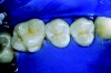 Figure 19. Deep occlusal fissures.