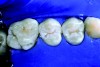 Figure 20. Occlusal sealant.