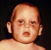 Figure 7. Bilateral injuries to an infant’s face, indicative of physical abuse.