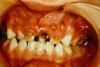 Figure 13. Dental neglect as indicated by multiple paruli from gross caries.