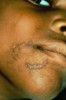 Figure 12. A bite mark reported as a dog bite; note the marks of a human adult dentition.