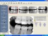 Figure 3. One of the steps in digital imaging is to create a patient file in the computer software to acquire and archive radiographic images. In this example, a bitewing template was selected, and then the images were captured and displayed on the monitor. (Patterson Dental Supply, Inc)
