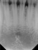 Figure 4. One of the most frequently reported intraoral digital imaging errors is cutting off of the teeth crowns. This error is more common with rigid intraoral sensors than flexible plates.