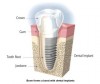 Figure 1 – Comparison between the tooth (left side) and implant (right side) attachment into bone (Courtesy of Nobel Biocare)