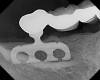 Figure 2 – Blade implant design