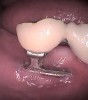 Figure 3 – Exposure of the implant was a common complication