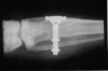 Figure 4 – Radiograph of the microscope bone chamber used by Dr. Brånemark in a rabbit fibula to study bone healing (Courtesy of Nobel Biocare)