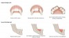 Figure 9 – Bone loss is the end result of tooth loss