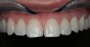 Figure 10 – Implant restoration on tooth #11 (Courtesy of Dr. Dell Goodrick)