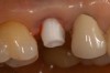 Figure 13 – Zirconia abutment torque onto implant