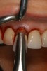 Figure 15 – Extraction of anterior tooth No. 8 without detaching the gingiva.