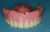 Figure 24 – Overdenture with flange to restore lip support