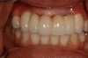 Figure 34 – Metal-free fixed partial denture cemented on the abutments.