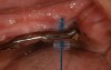 Figure 37 – Proxybrush is one tool that can be used to clean under the overdenture bars.