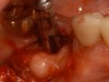 Figure 43 – Gingiva incised and a trephine drill used to remove the fractured implant.