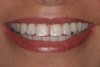 Figure 44 – Smile of a patient with a dental implant.