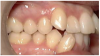 Figure 1. Class I malocclusion.