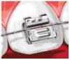 Figure 10. Self-ligating bracket.