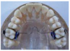 Figure 18. Transpalatal arch.