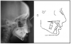 Figure 21. Cephalometric radiographic images can be superimposed to study changes in jaw and tooth position.