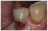 Figure 1: Root Caries<br>Courtesy of <a href-