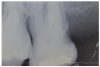 Figure 2: Radiographic Image of root caries<br>Courtesy of <a href-