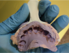 Figure 4: Preoperative anterior triple tray impression with an orientation notch drilled into the handle to indicate both the maxillary side and the incisor midline.