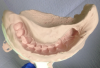 Figure 8: Same preoperative impression in Figure 7; edentulous space was cut out with a scalpel blade to create space for temporary restoration material to form the temporary bridge pontic.