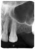 Figure 2 - Advanced Enamel Caries