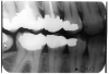 Figure 4 - Recurrent Caries