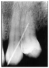 Figure 6 - Probe Depth in Moderate Periodontal Disease