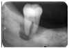 Figure 7 - Extensive Loss of Alveolar Bone