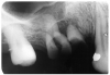 Figure 8 - Calculus on Distal of Maxillary Molar