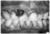 Figure 9 - Gingival Hyperplasia