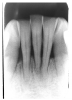 Figure 10 - Horizontal Bone Loss