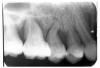 Figure 11 - Vertical Bone Loss