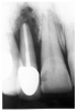 Figure 12 - Radiolucent Foraminae