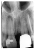 Figure 13 - Apical Periodontal Pathosis