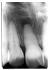 Figure 14 - Apical Periodontal Cyst