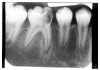 Figure 16 - Condensing Osteitis