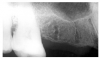 Figure 18 - Fibrous Tissue Healing