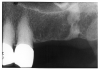 Figure 19 - Socket Sclerosis